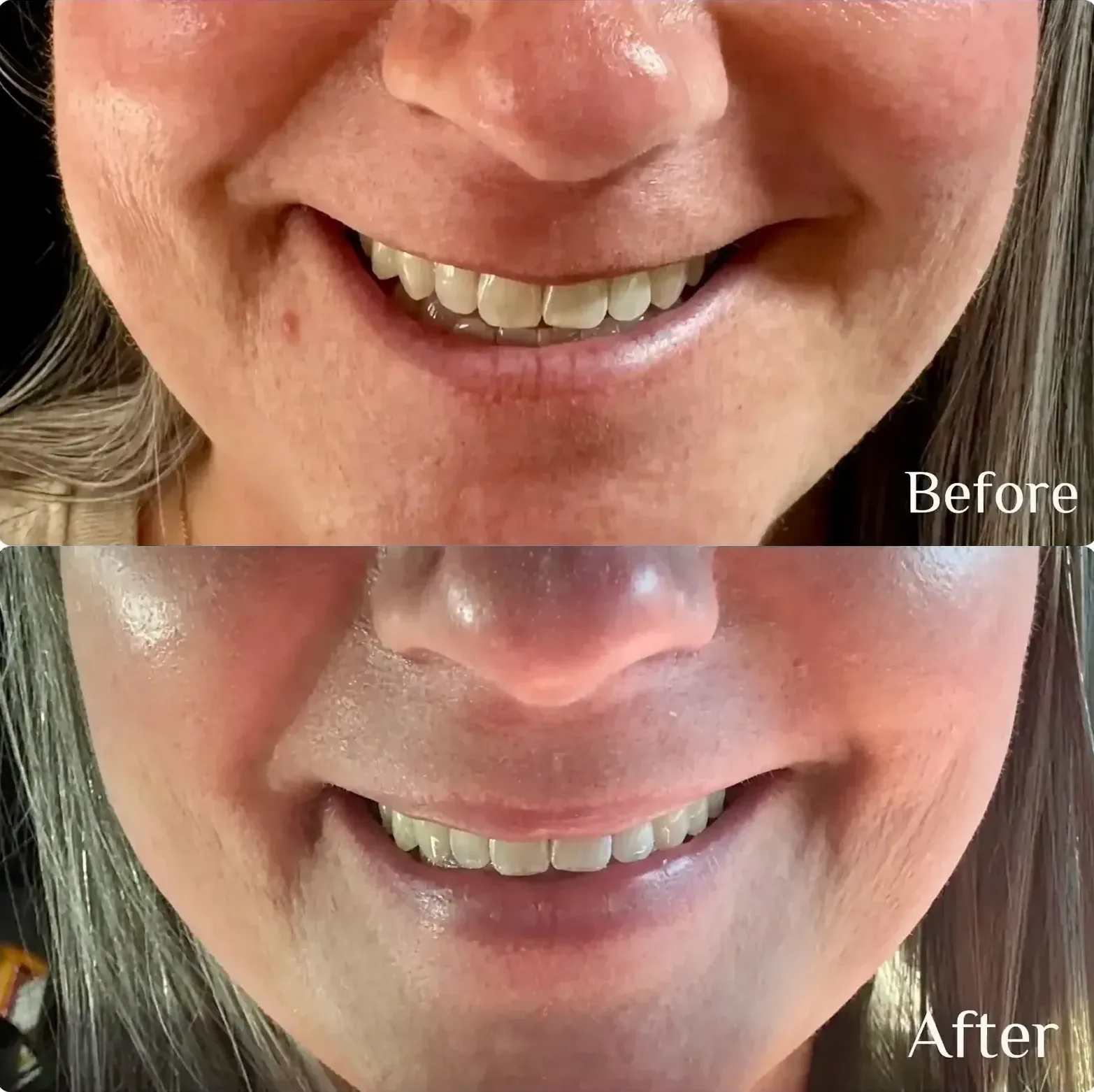 Before and after lip flip treatment