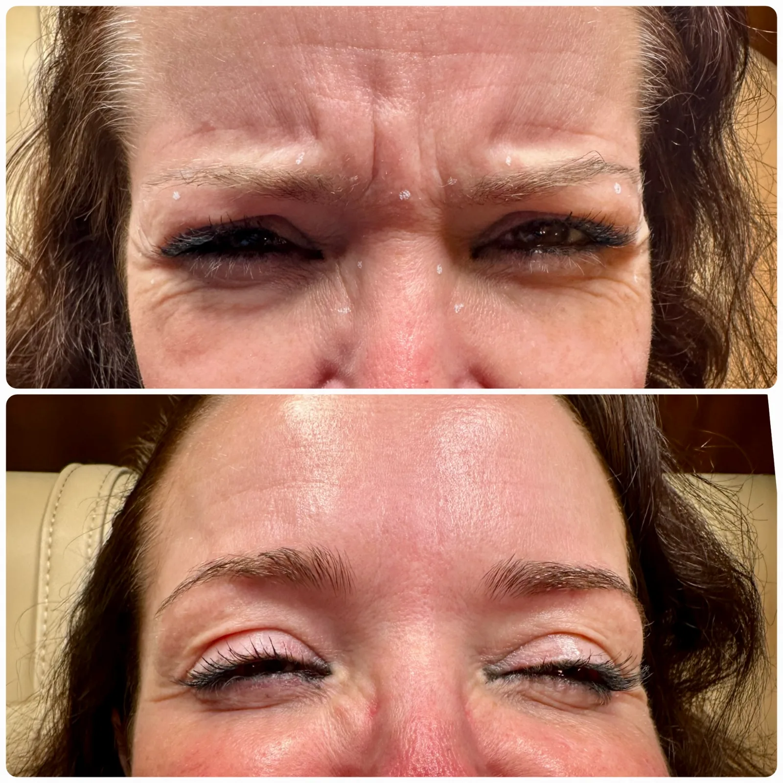 Frown lines between the brows before and after Letybo