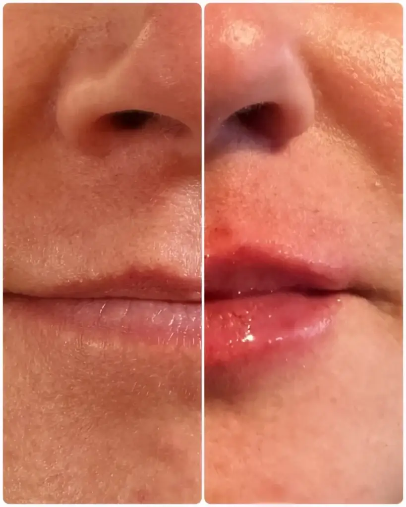 Lip Filler After Care: Essential Leander Recovery Guide